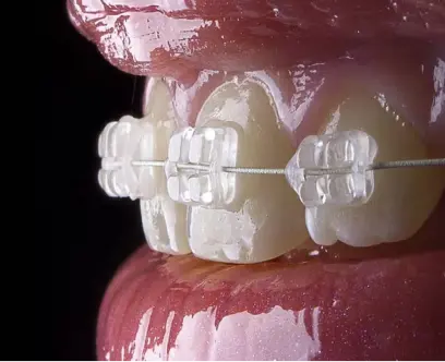 Aparelho Ortodôntico